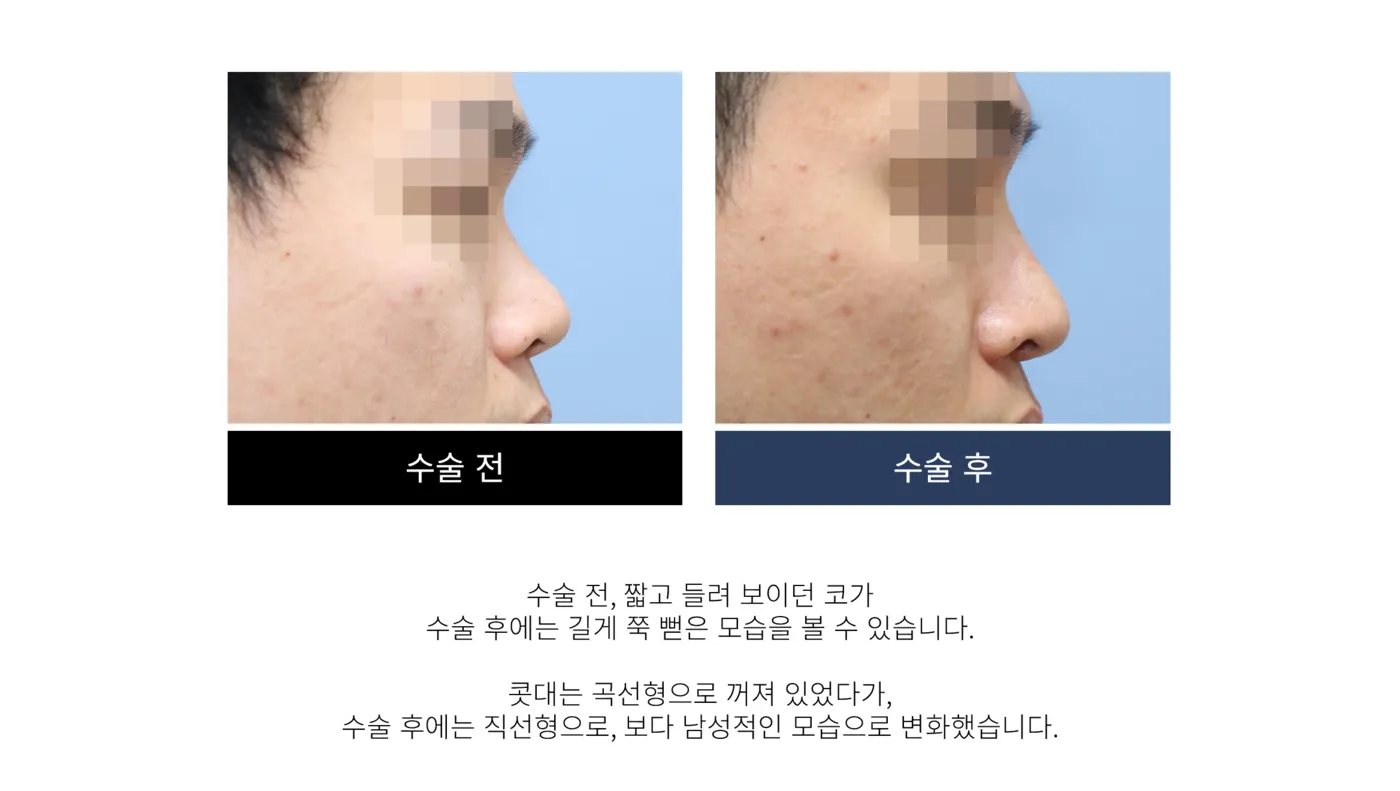 첫 코 성형 - 리숨