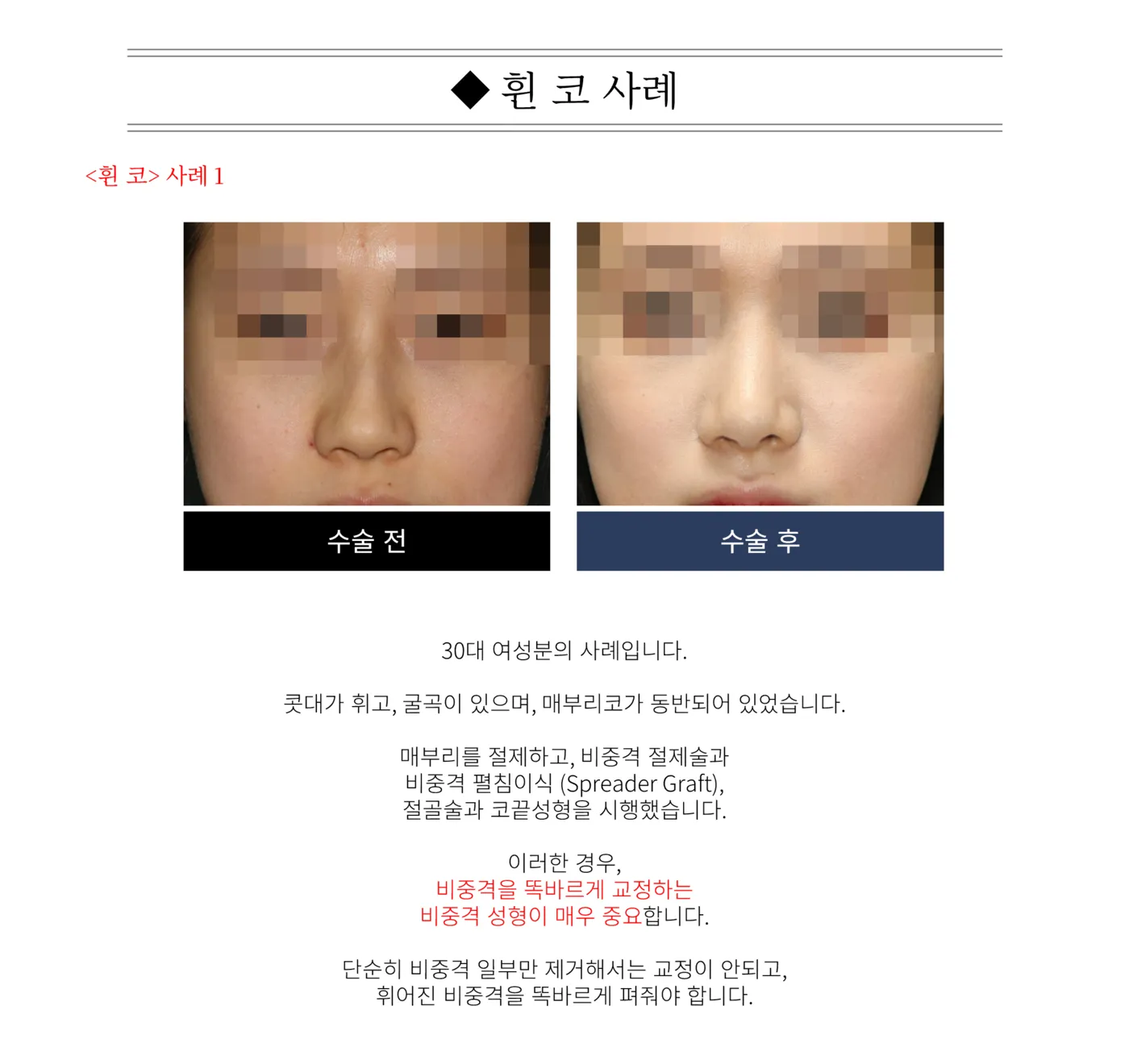 첫 코 성형 - 리숨