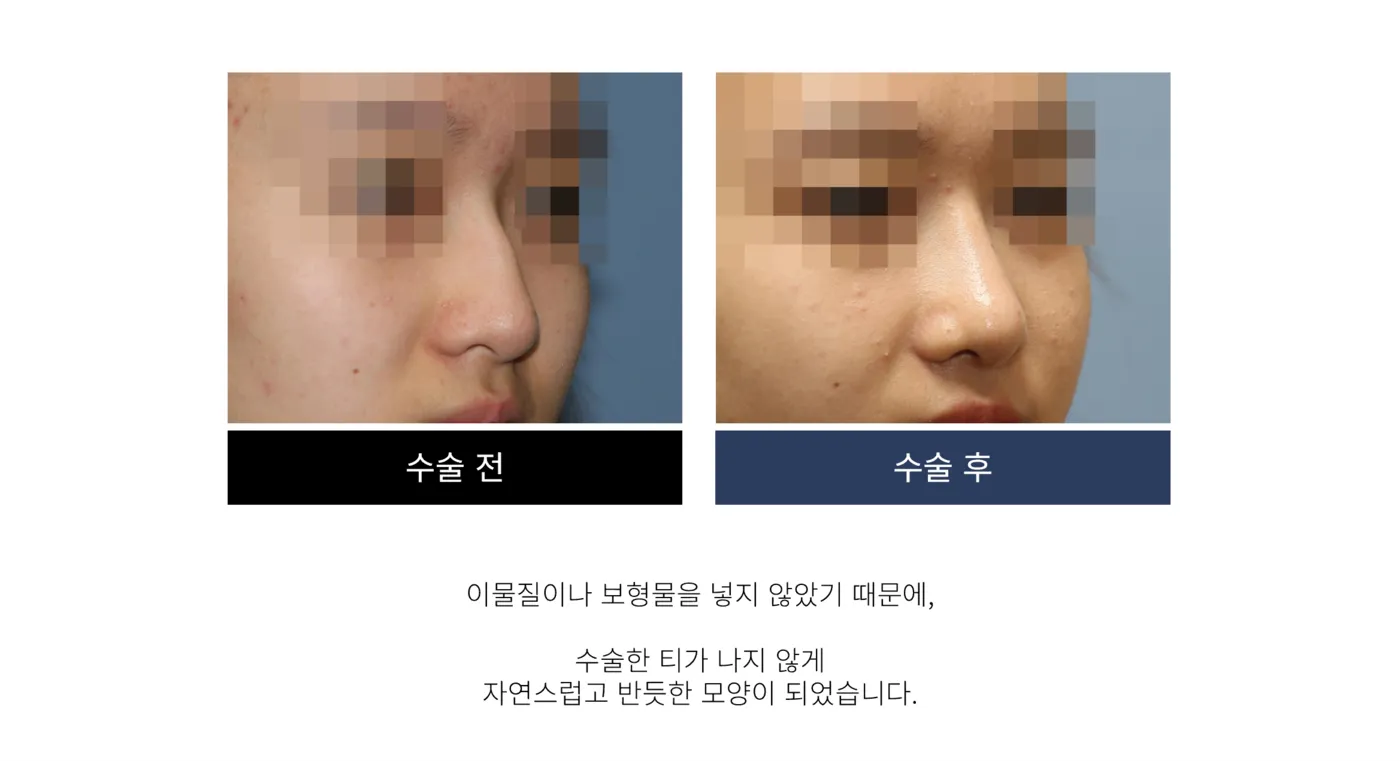 첫 코 성형 - 리숨